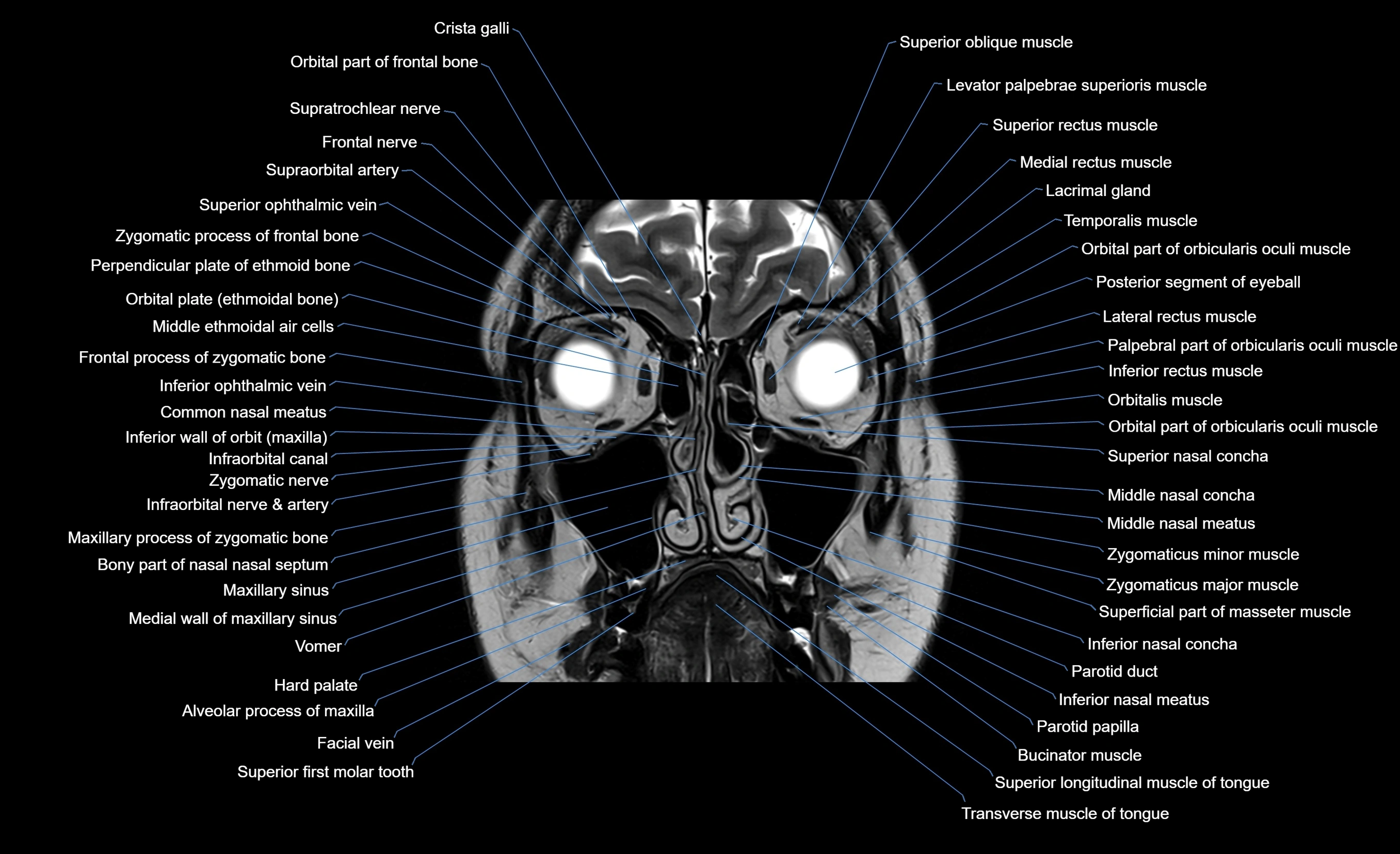 MRI face & paranasal sinuses(PNS) labelled  coronal  cross sectional anatomy 3T radiology  image-img-00001-00020.webp